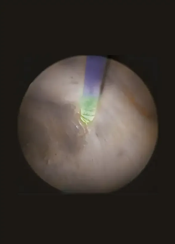 Endoskopski prikaz holmijum lasera koji precizno uklanja tkivo prostate tokom HoLEP procedure